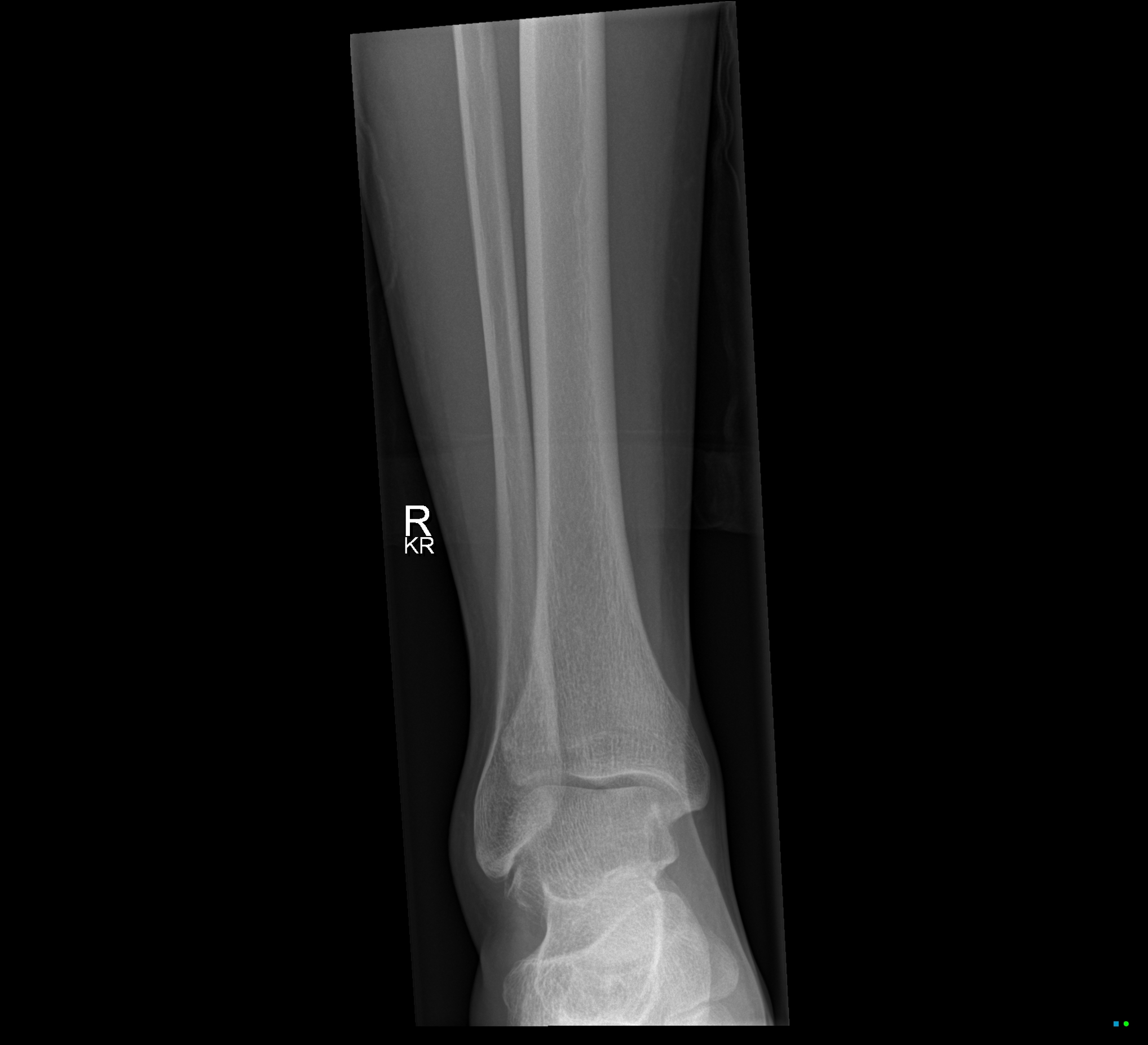 Lateral process of talus fracture Image