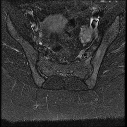 Acute sacroiliitis - unilateral | Image | Radiopaedia.org