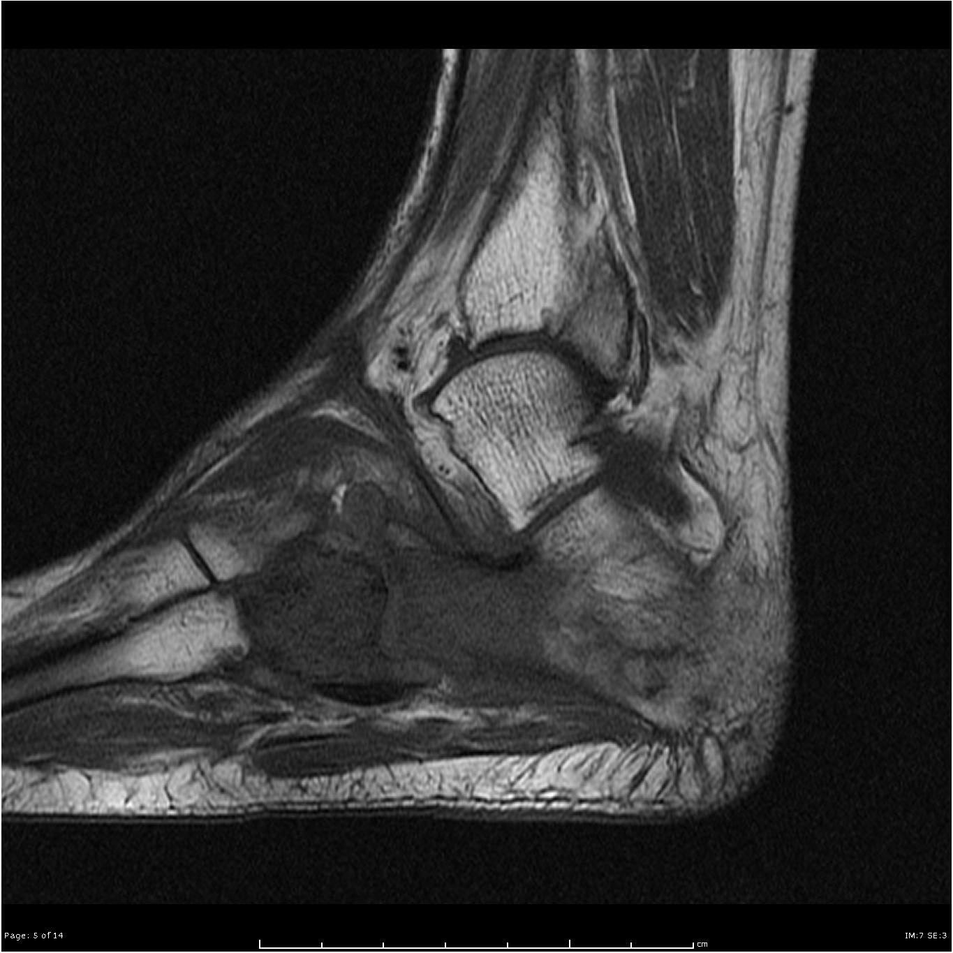 Tuberculous Osteomyelitis Image