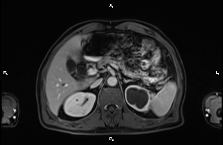 Choledocholithiasis | Image | Radiopaedia.org