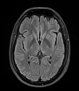 Diffuse axonal injury involving corticospinal tract | Image ...