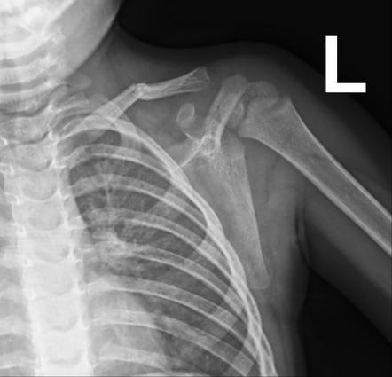 Clavicle Fracture | Radiology Case | Radiopaedia.org