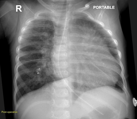 Migrated VSD closure device | Radiology Case | Radiopaedia.org