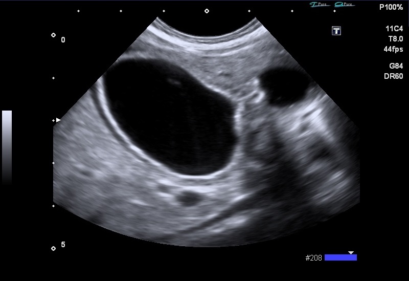 Gastric duplication cyst | Image | Radiopaedia.org