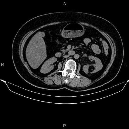 Renal angiomyolipoma | Radiology Case | Radiopaedia.org