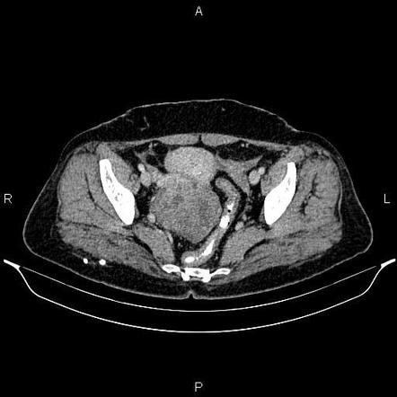 Ovarian serous cystadenocarcinoma | Radiology Reference Article ...