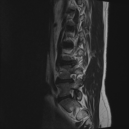 Extraforaminal disc protrusion | Image | Radiopaedia.org