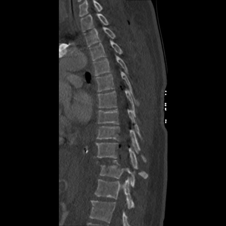 Pneumorrhachis | Radiology Reference Article | Radiopaedia.org