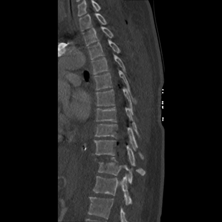 Unstable thoracic spine fracture dislocation | Radiology Case ...