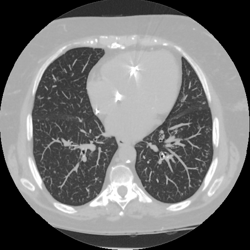 File:Diffuse pulmonary meningotheliomatosis, primary lung ...