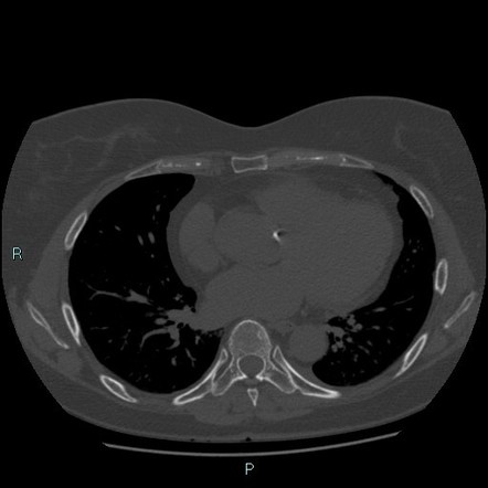 Bifid Curved Xiphoid Process | Image | Radiopaedia.org