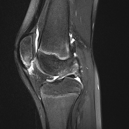 Patellar Sleeve Avulsion 