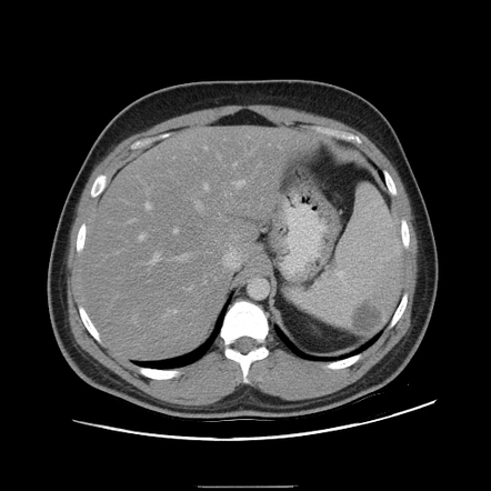 Splenic infarction | Radiology Reference Article | Radiopaedia.org