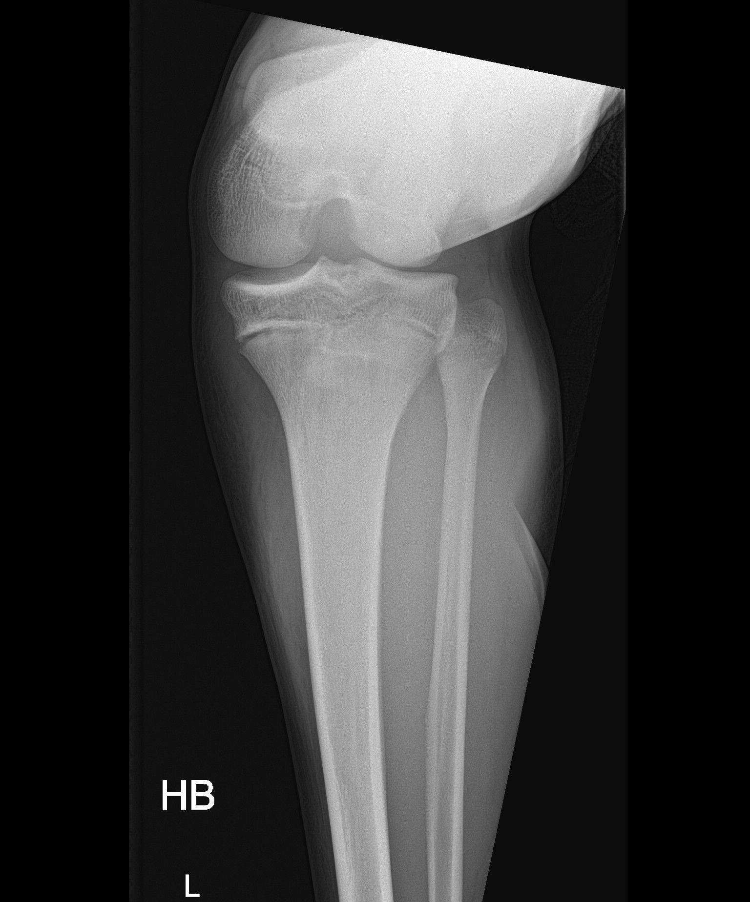 Tibial Tuberosity Avulsion Fracture | Image | Radiopaedia.org