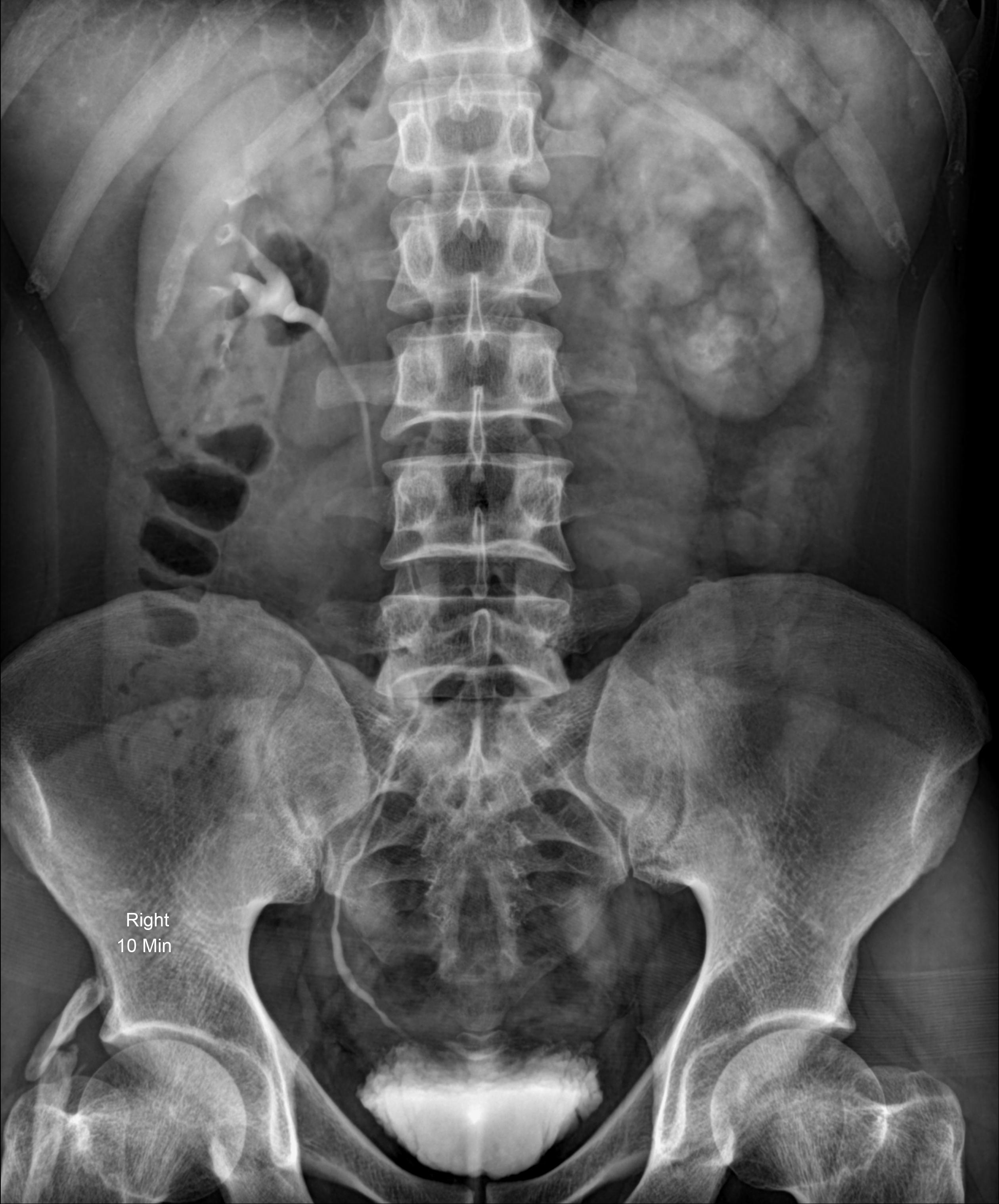 Left renal pelvic calculus | Image | Radiopaedia.org