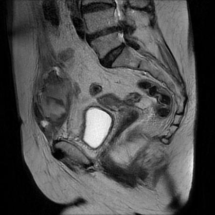 Rectus sheath hematoma | Radiology Case | Radiopaedia.org