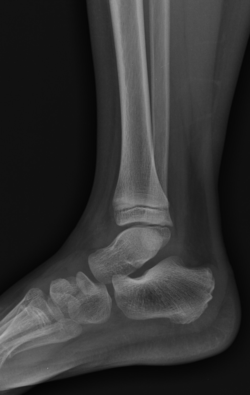 Anterior talofibular ligament bony avulsion - pediatric | Image ...