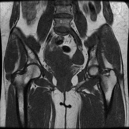 Greater Trochanter Pain Syndrome 