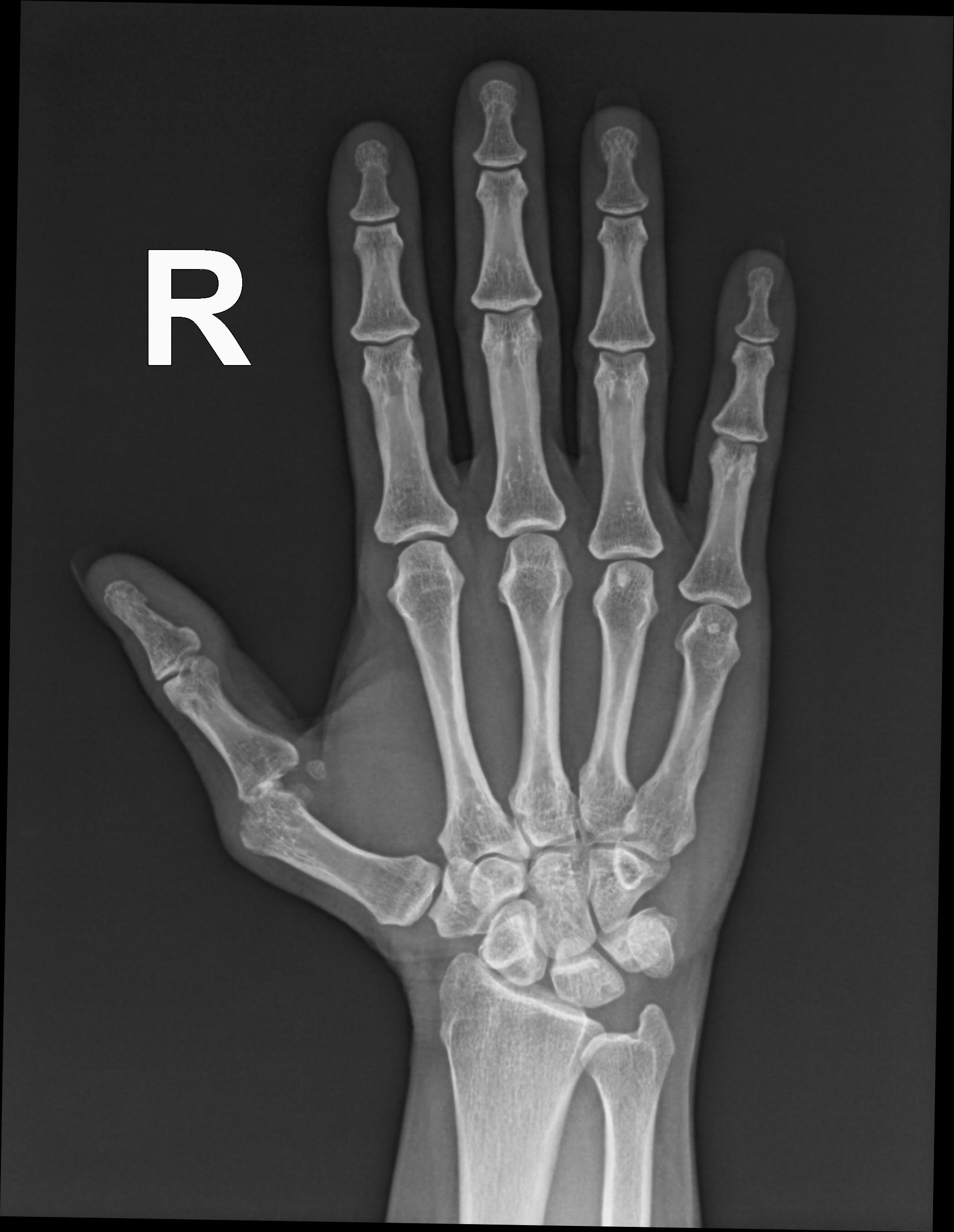 First metacarpophalangeal joint subluxation | Image | Radiopaedia.org