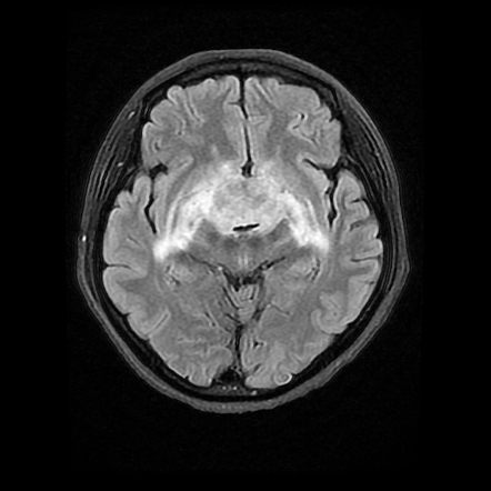 Chordoid glioma of third ventricle | Image | Radiopaedia.org