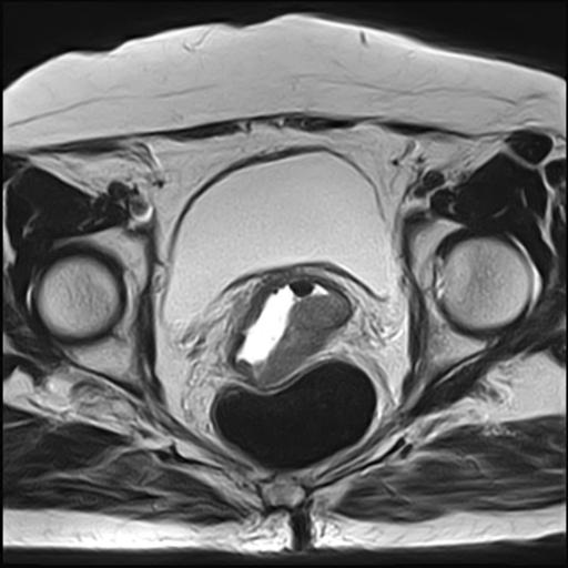 Vaginal Squamous Cell Carcinoma Image