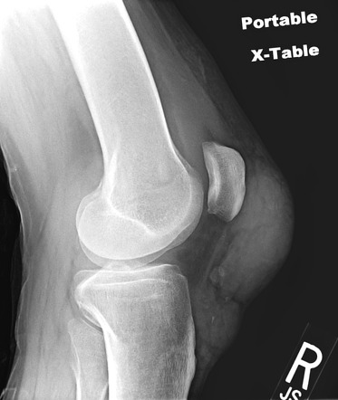 Gout Radiology Reference Article Radiopaedia Org