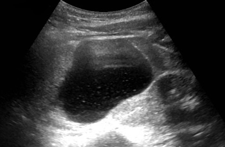 Biliary cystadenoma | Image | Radiopaedia.org