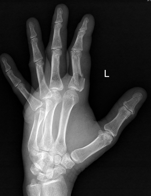 Proximal phalanx fracture | Radiology Reference Article | Radiopaedia.org