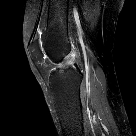 Anterior Cruciate Ligament Mucoid Degeneration 