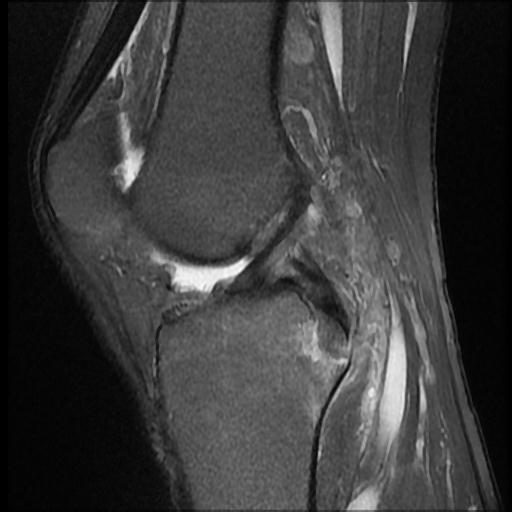 Posterior cruciate ligament avulsion fracture | Image | Radiopaedia.org