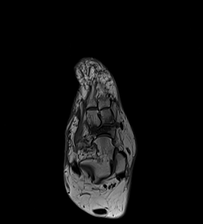 Müller-Weiss syndrome | Radiology Reference Article | Radiopaedia.org