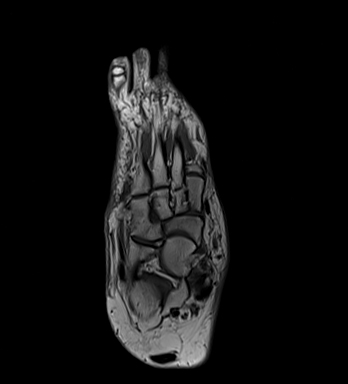 Mueller Weiss syndrome | Image | Radiopaedia.org