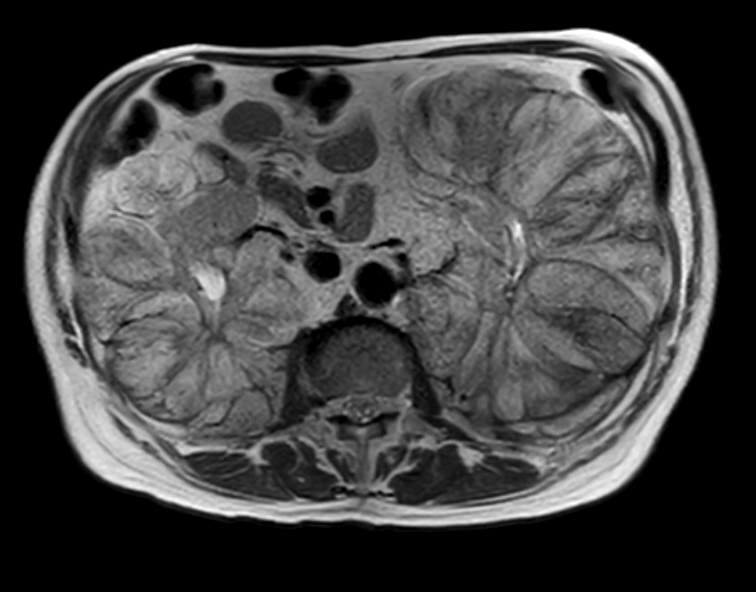 Erdheim Chester Disease Image