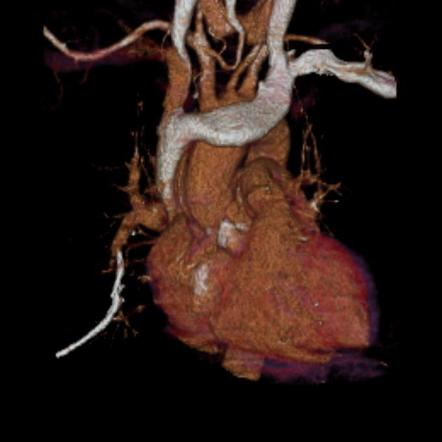 Catheter pulmonary embolism | Radiology Case | Radiopaedia.org