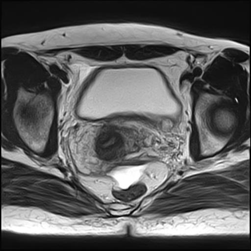 Uterine Arteriovenous Malformation Image