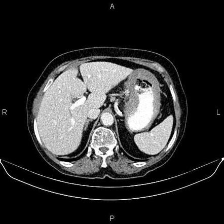 Linitis plastica | Radiology Case | Radiopaedia.org