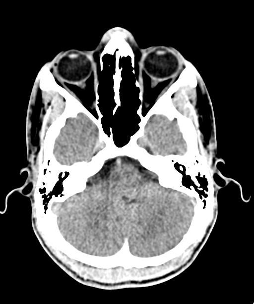 Intraorbital foreign body | Image | Radiopaedia.org