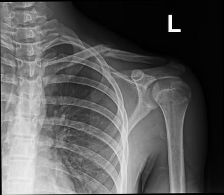 Clavicle fracture | Radiology Case | Radiopaedia.org