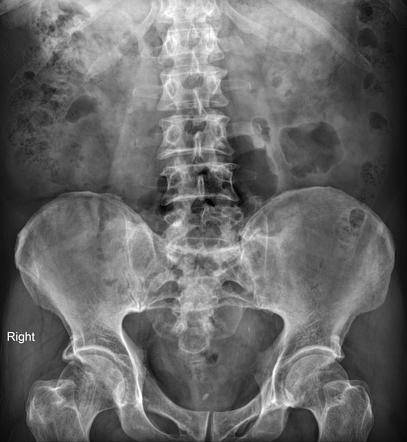 Multifocal urethral strictures in a patient with hypospadias | Image ...