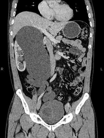 Duplex collecting renal system | Radiology Case | Radiopaedia.org