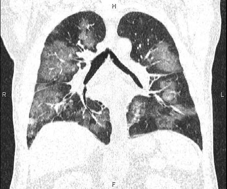 COVID-19 pneumonia | Radiology Case | Radiopaedia.org