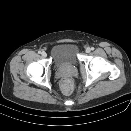 Rectal cancer | Radiology Case | Radiopaedia.org