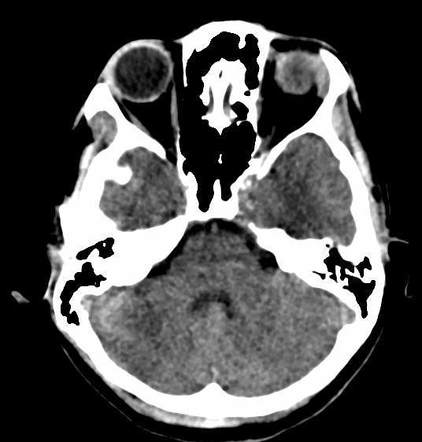 Calcified cavernous internal carotid arteries in a young patient ...