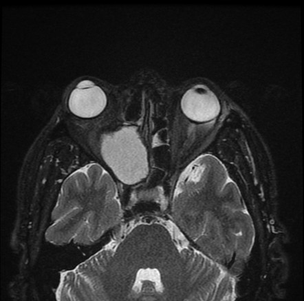 Frontoethmoidal mucocele | Radiology Reference Article | Radiopaedia.org