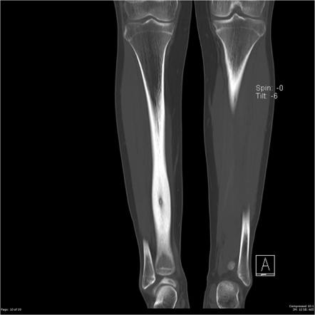 Osteoid osteoma (tibia) | Image | Radiopaedia.org