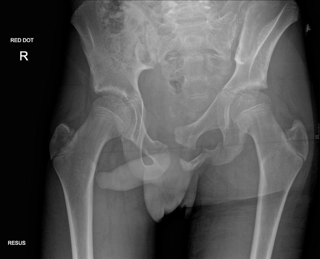 Open book pelvic injury, Radiology Reference Article