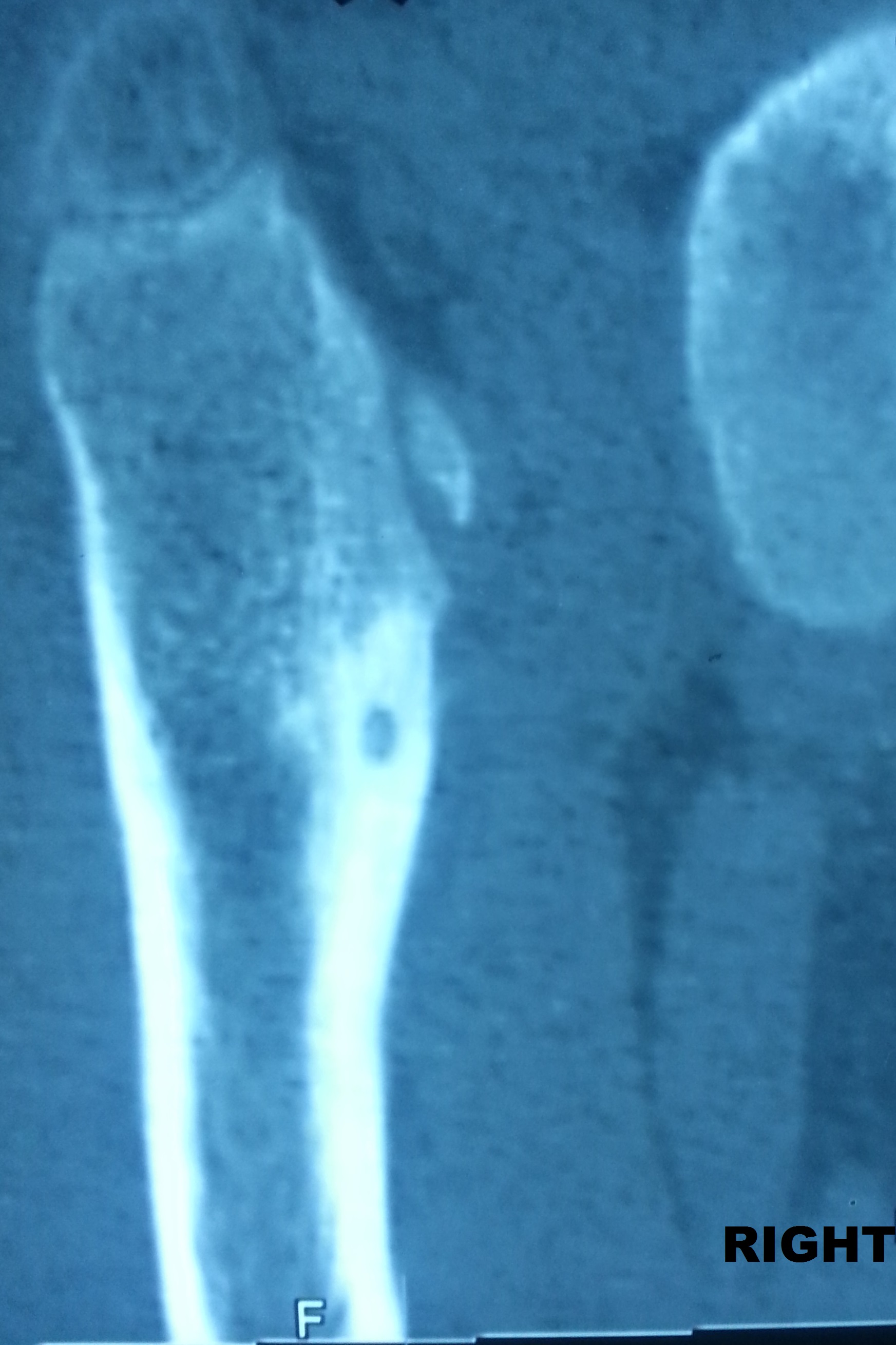 Chronic Osteomyelitis Image