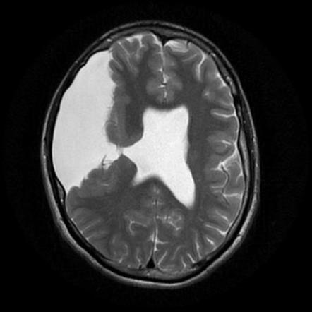 Schizencephaly | Radiology Reference Article | Radiopaedia.org