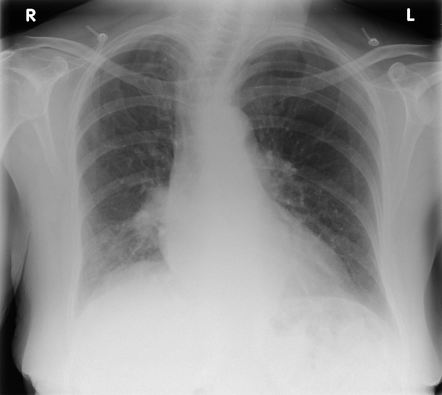 Fleischner sign (enlarged pulmonary artery) | Radiology Reference ...