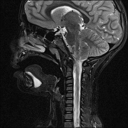 Ranula | Radiology Reference Article | Radiopaedia.org